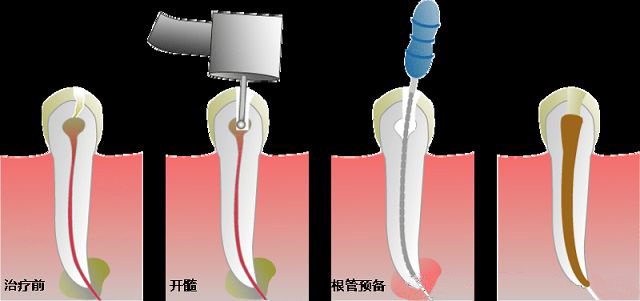 根管治疗是什么