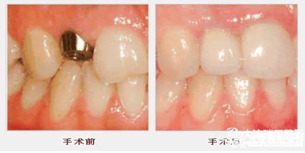 镶牙材料越贵越好吗