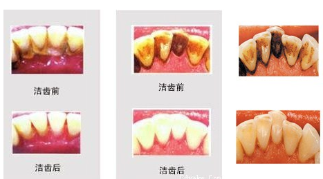 牙菌斑怎么去除呢