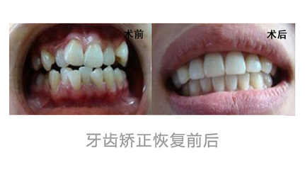 隐形正畸有哪些特点