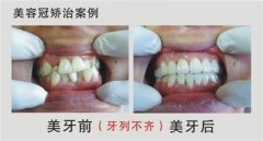 为什么有些人牙齿会不齐呢?
