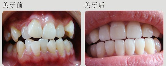 牙列不齐有哪些危害