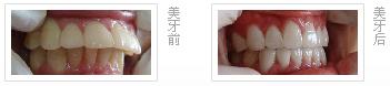 牙齿前突矫正效果能够维持多久