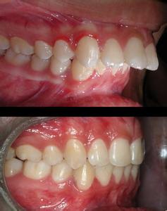种植修复:牙齿完整,牙周情况不是太差的门牙前突病例,一般不会考虑