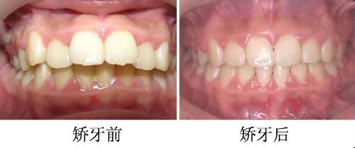 牙齿外突是如何造成的?
