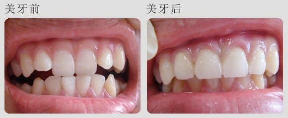 成人牙齿矫正效果好吗