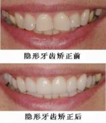 牙齿隐形矫正有哪些优势呢