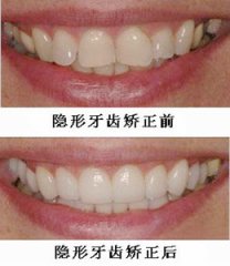 牙齿隐形矫正有哪些优点