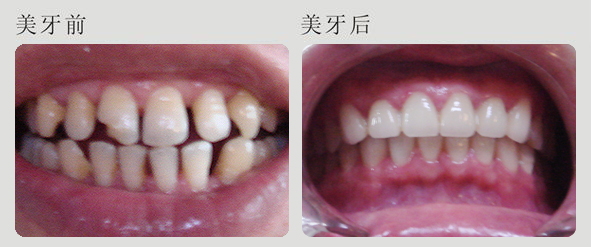 牙齿稀疏