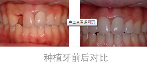 种植牙成为门牙缺失修复首选
