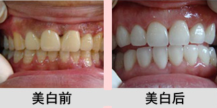 去除烟渍牙的方法有哪些