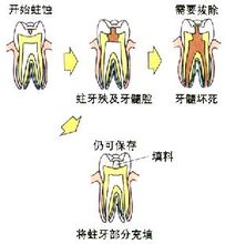 有牙洞不及时修补危害大吗