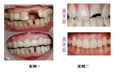 美容冠是怎么矫正牙齿的