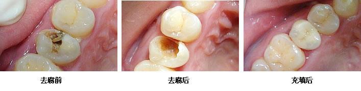 补牙一般多少钱