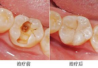 补牙用什么材料好费用多少