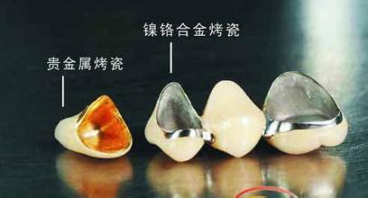 全瓷牙与烤瓷牙的区别