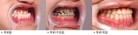 地包天牙齿矫正贵不贵