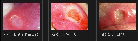 治疗口腔溃疡大概多少钱