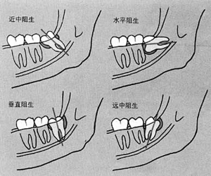 长了智齿一定要拔吗