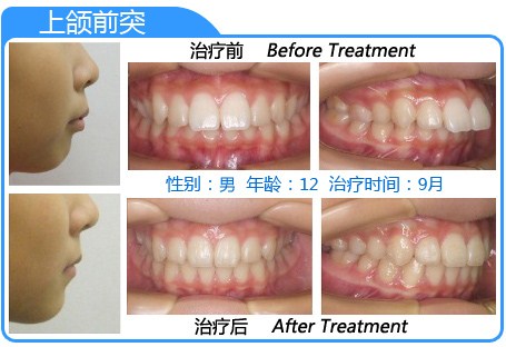 牙齿前凸怎么办
