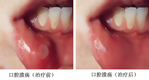 反复性口腔溃疡怎么办?