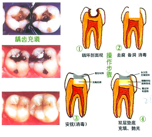 补牙