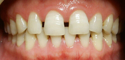 牙间隙的危害有哪些