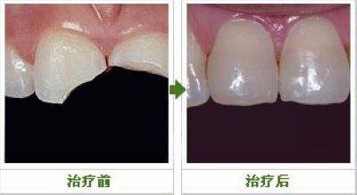 漳州牙齿缺损会带来什么危害