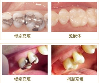 漳州补牙材料有哪些
