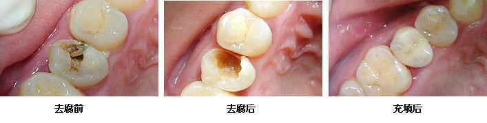 漳州补牙一颗多少钱