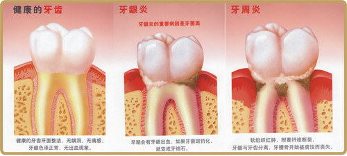 漳州牙周炎有哪些危害