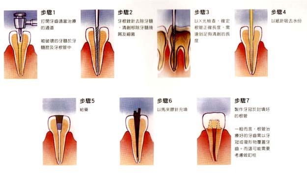 漳州根管治疗有哪些注意事项