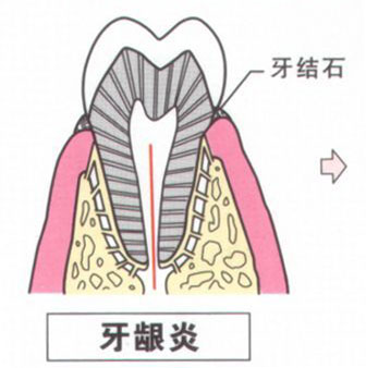 漳州牙龈炎的危害有哪些