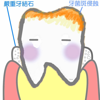 漳州牙菌斑有哪些类型