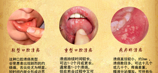 漳州引起口腔溃疡的原因有哪些
