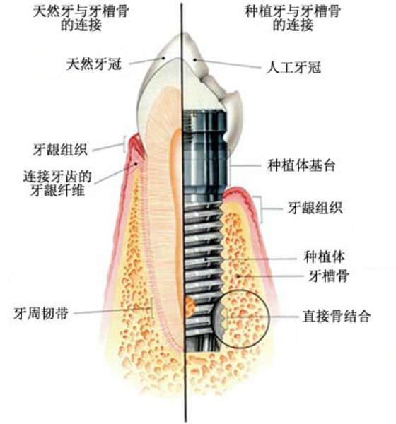 漳州牙齿全口缺失做种植牙好吗