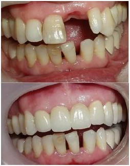 漳州门牙缺失有哪些修复方式