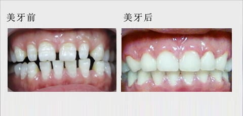 漳州牙齿稀疏有哪些方式可以修复
