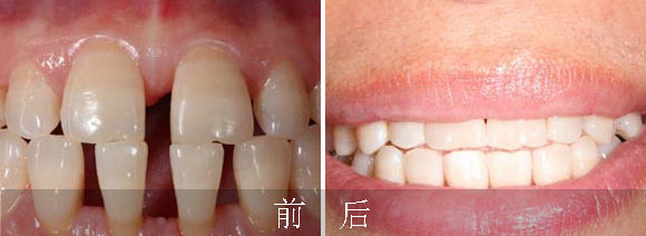 漳州牙齿稀疏矫正费用大概多少钱