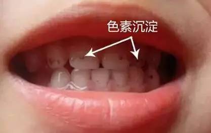 儿童牙齿发黑脱落是由于牙釉质发育不全,如宝宝缺钙就会使得牙釉质