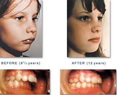 儿童牙齿矫正的最佳年龄段是什么时候